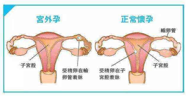 孕妇几个月容易流产，深入了解与预防策略